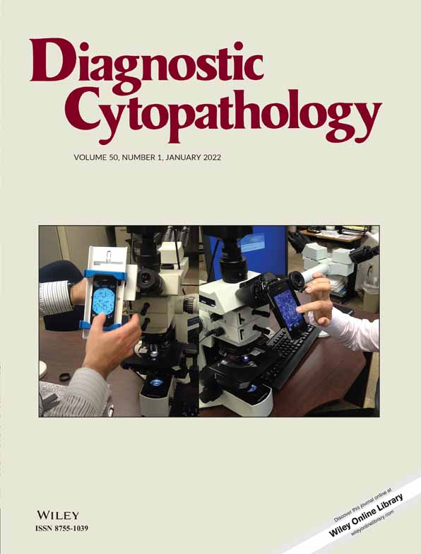 Basaloid squamous cell carcinoma of anal canal with adenoid cystic pattern and liver metastasis: A rare case report