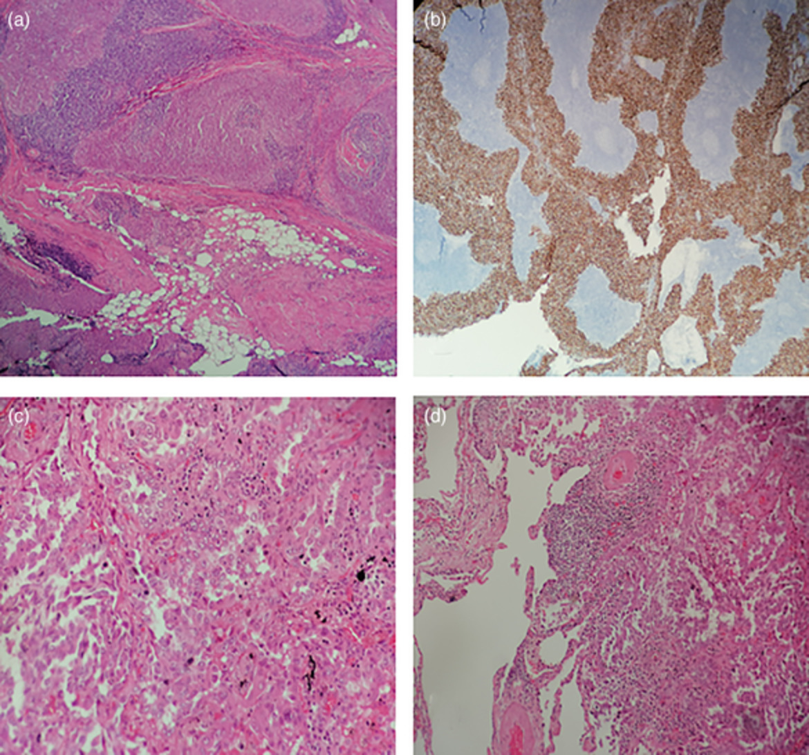 Uniportal video‐assisted thoracic surgery approach for simultaneous lung cancer and thymic carcinoma: Case report and literature review