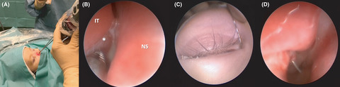 Surgical treatment of a congenital dacryocystocele by means of microdebrider marsupialization in a newborn