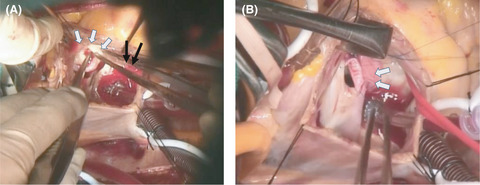 Incidentally detected atrioventricular septal defect in an adult