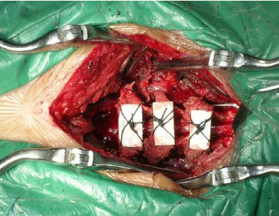 Longitudinal Spinous‐Splitting Laminoplasty with Coral Bone for the Treatment of Cervical Adjacent Segment Degenerative Disease: A 5‐Year Follow‐up Study