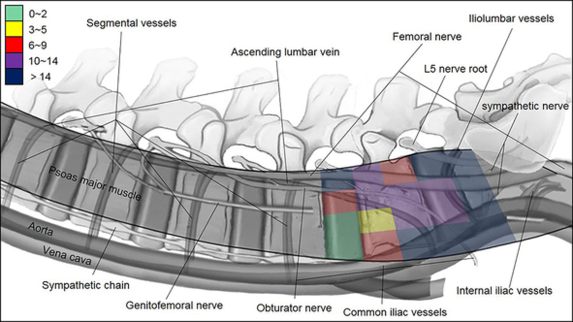 A Crucial But Neglected Anatomical Factor Underneath Psoas Muscle and Its Clinical Value in Lateral Lumbar Interbody Fusion—The Cleft of Psoas Major (CPM)