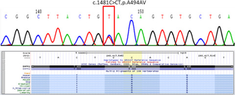 Identification of a novel mutation in the BMPR2 gene in a pulmonary arterial hypertension patient using next‐generation sequencing