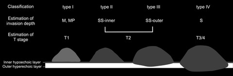 An intact boundary between the tumor and inner hypoechoic layer discriminates T1 lesions among sessile elevated gallbladder cancers