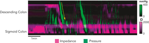 High‐resolution impedance manometry characterizes the functional role of distal colonic motility in gas transit