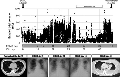 COVID‐19 case of ventilator‐induced lung injury on extracorporeal membrane oxygenation: Physicians' clinical struggle and ethical conflict in a novel pandemic