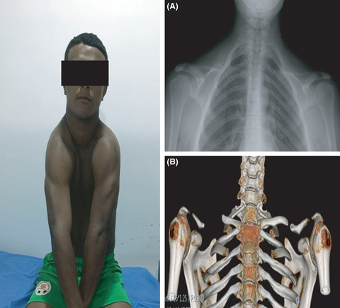 Clinical‐radiological approach for the diagnosis of cleidocranial dysplasia in adults: A familial cases series