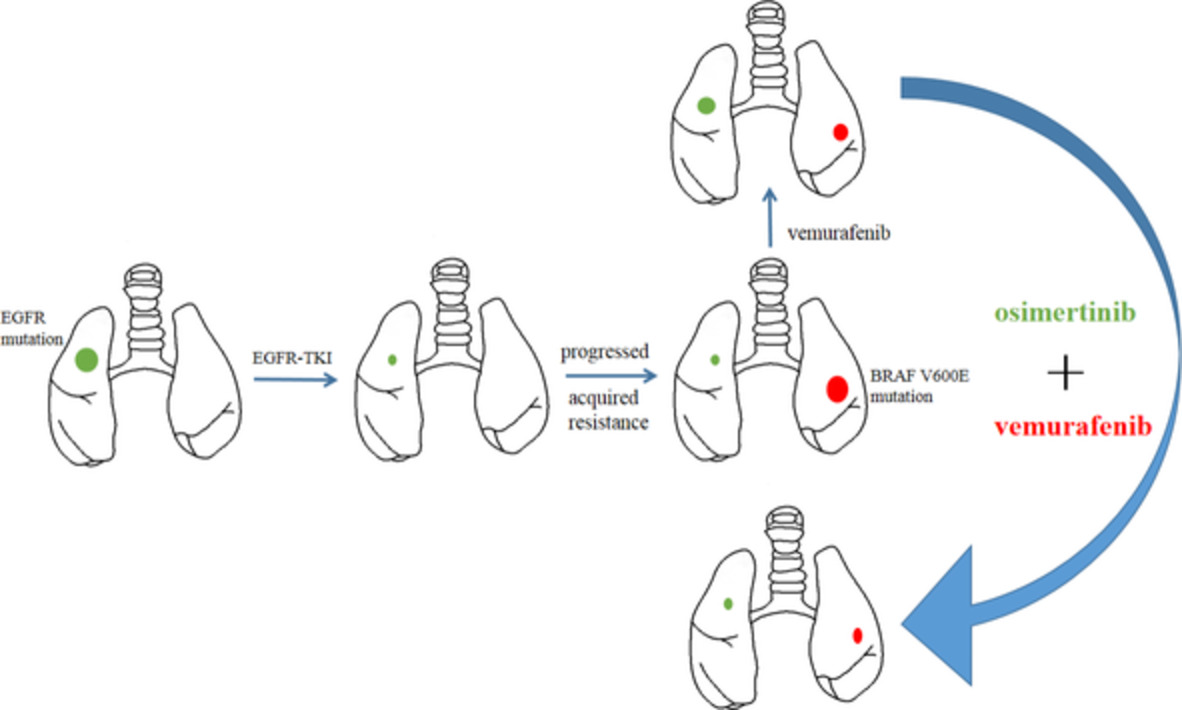 Combined targeting of EGFR and BRAF triggers regression of osimertinib resistance by using osimertinib and vemurafenib concurrently in a patient with heterogeneity between different lesions