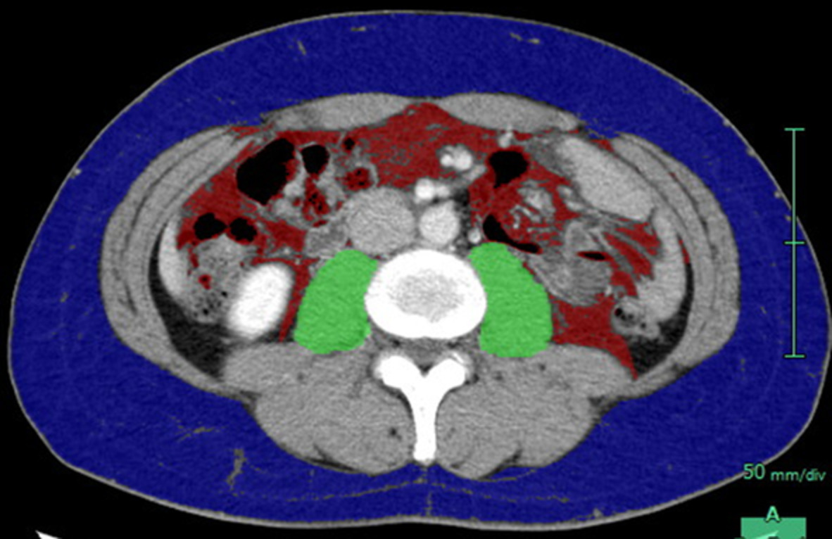 Impact of sarcopenia on chemotherapy‐triggered exacerbation of interstitial lung disease in patients with non‐small cell lung cancer