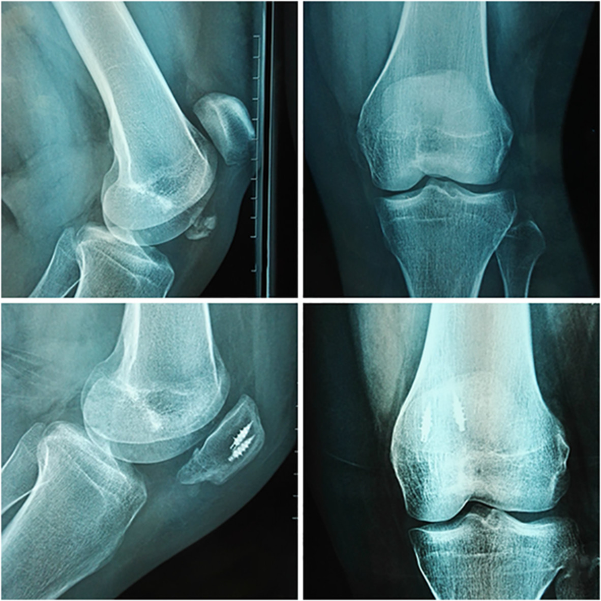 Anchor and Krackow‐“8” Suture for the Fixation of Distal Pole Fractures of the Patella: Comparison to Kirschner Wire