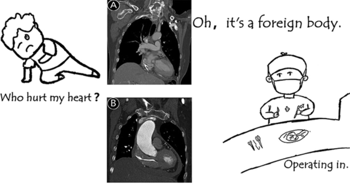 Cardiac Perforation Caused by Cement Embolism after Percutaneous Vertebroplasty: A Report of Two Cases