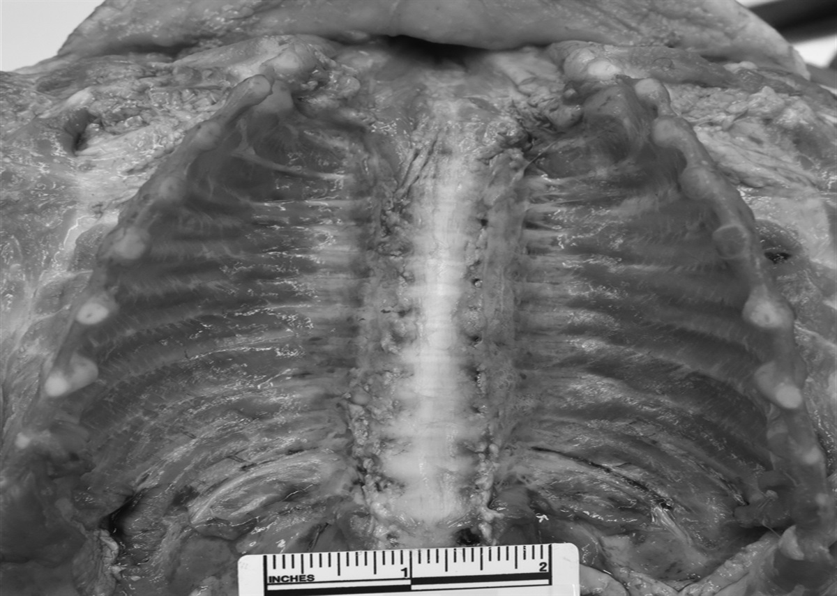 Cardiopulmonary Resuscitation Induced Posterior Rib Fractures in Nontraumatic Pediatric Deaths