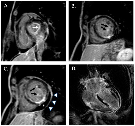 Cardiogenetics, Vol. 12, Pages 133-141: Pancarditis as the Clinical Presentation of Eosinophilic Granulomatosis with Polyangiitis: A Multimodality Approach to Diagnosis