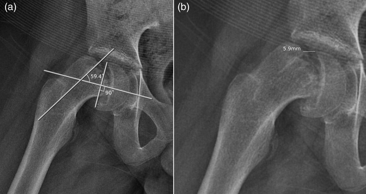 Controlled repositioning and primary osteoplasty as a treatment option for the management of unstable slipped capital femoral epiphysis