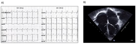 Cardiogenetics, Vol. 12, Pages 206-211: Clinical Exome Sequencing Revealed a De Novo FLNC Mutation in a Child with Restrictive Cardiomyopathy