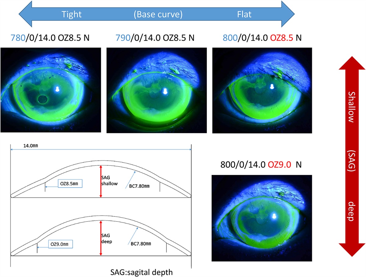 Erratum to Limbal-Rigid Contact Lens Wear for the Treatment of Ocular Surface Disorders: A Review