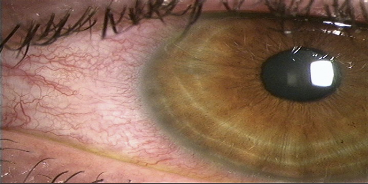 Topical Review: Contact Lens Eye Health and Safety Considerations in Government Policy Development