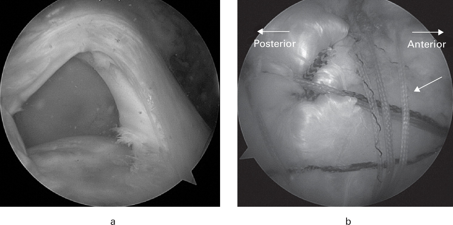 Arthroscopic biceps augmentation does not improve clinical outcomes during incomplete repair of large to massive rotator cuff tears