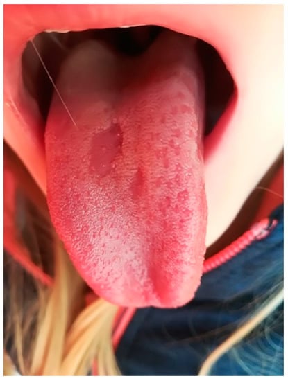 Dentistry Journal, Vol. 10, Pages 214: Oral Mucosal Lesions in Childhood