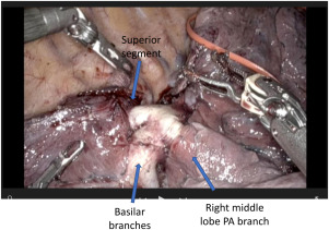 Robotic Lobectomy