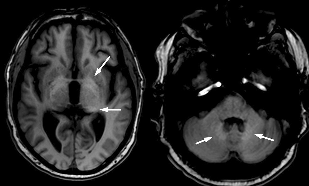 Is Gadolinium Staining of the Brain a Real Concern When Ordering Brain MRI?: Pro vs Con