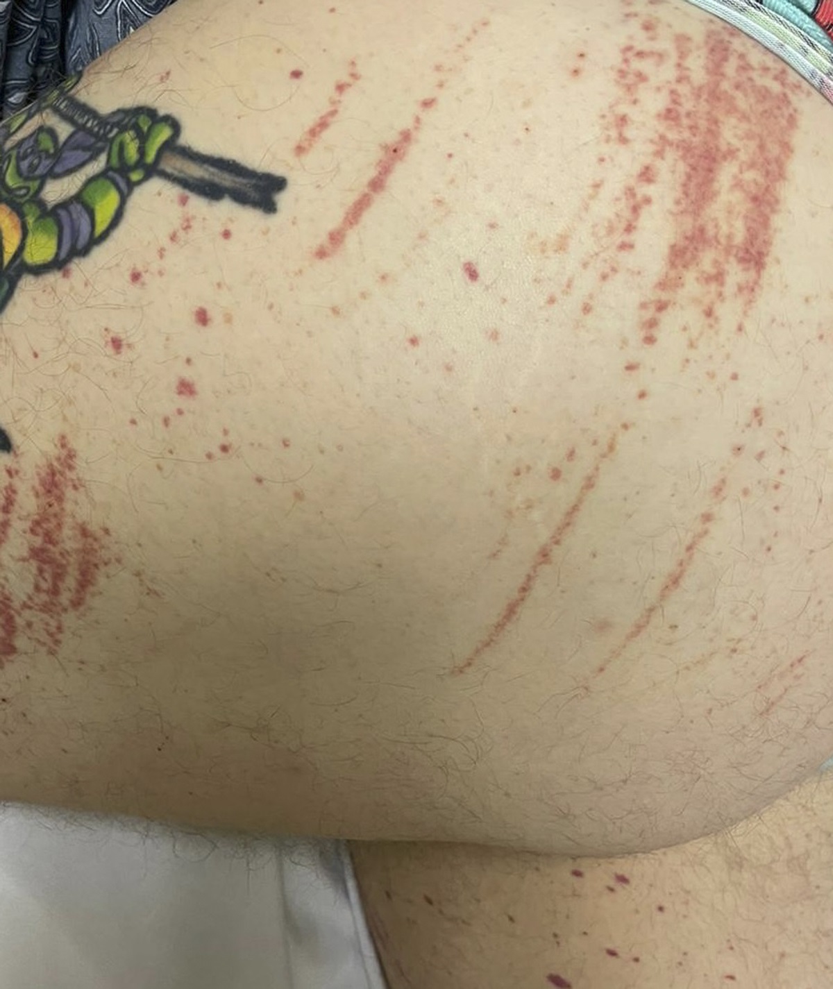 Atypical Presentation of Leukocytoclastic Vasculitis With Koebner Phenomenon