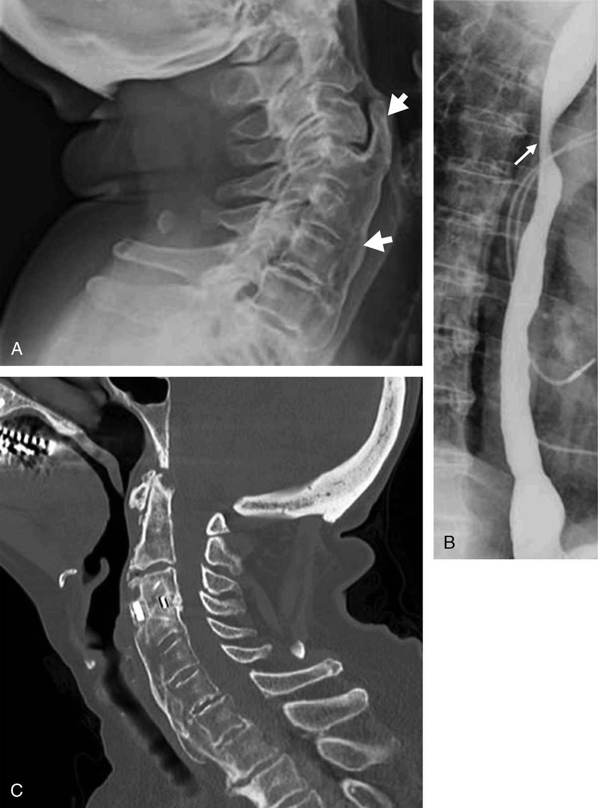 Dysphagia Due to Diffuse Idiopathic Skeletal Hyperostosis