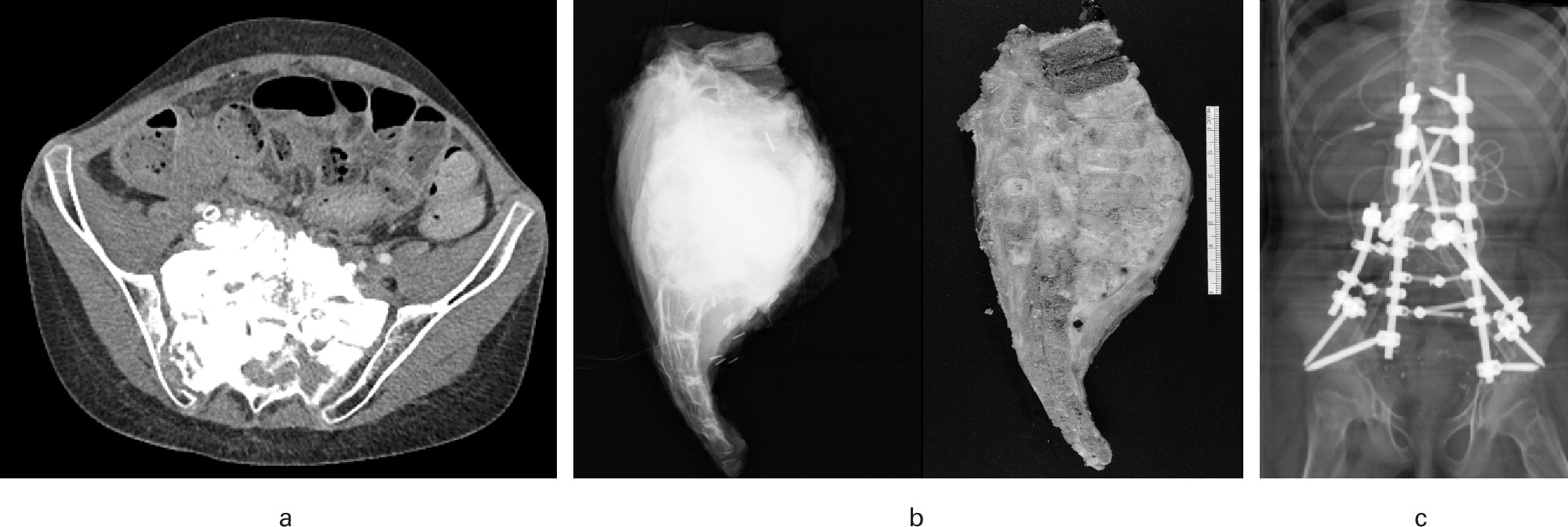 The management of sacral tumours