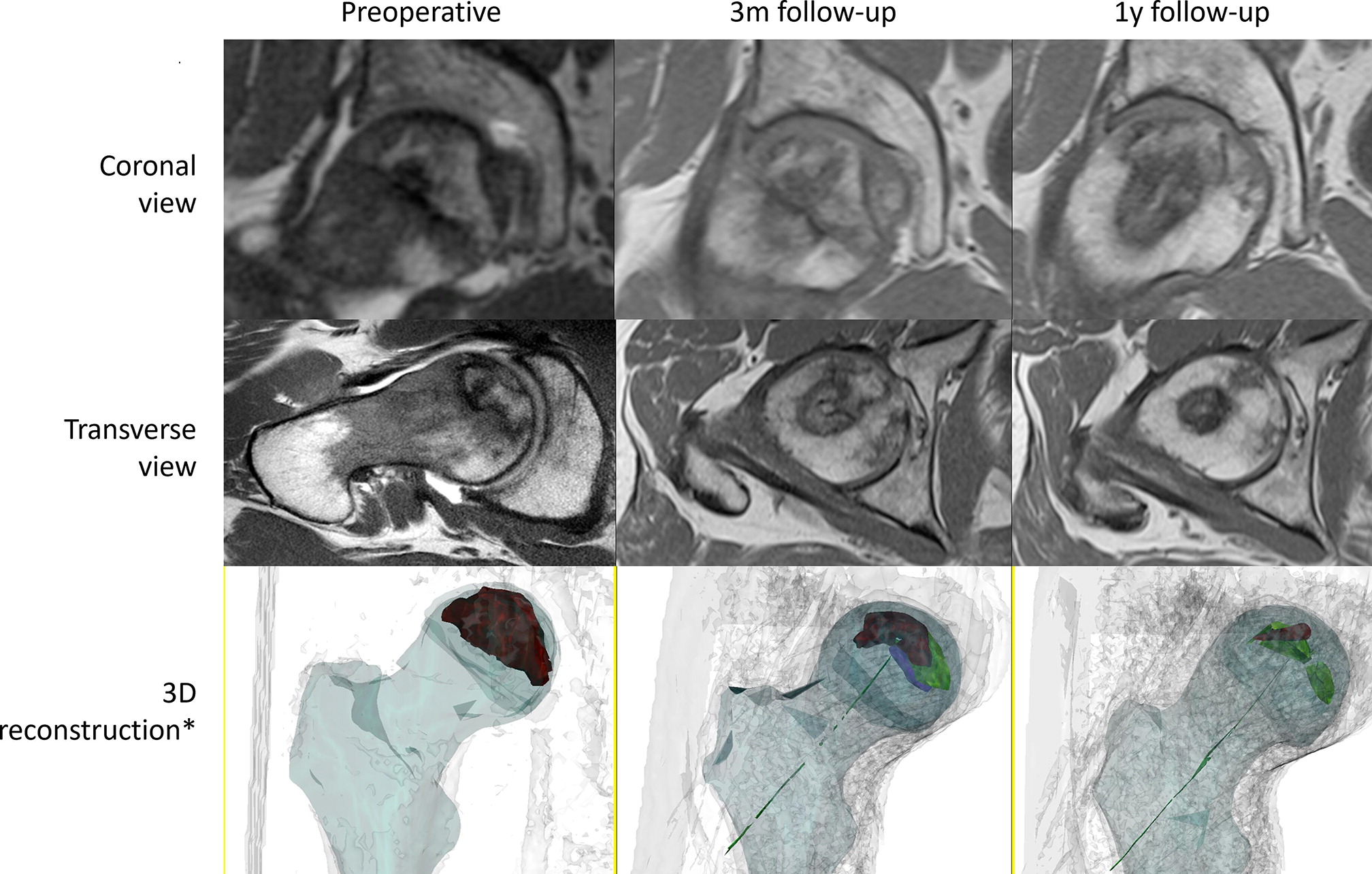 Volume and location of bone regeneration after autologous expanded mesenchymal stromal cells in hip osteonecrosis