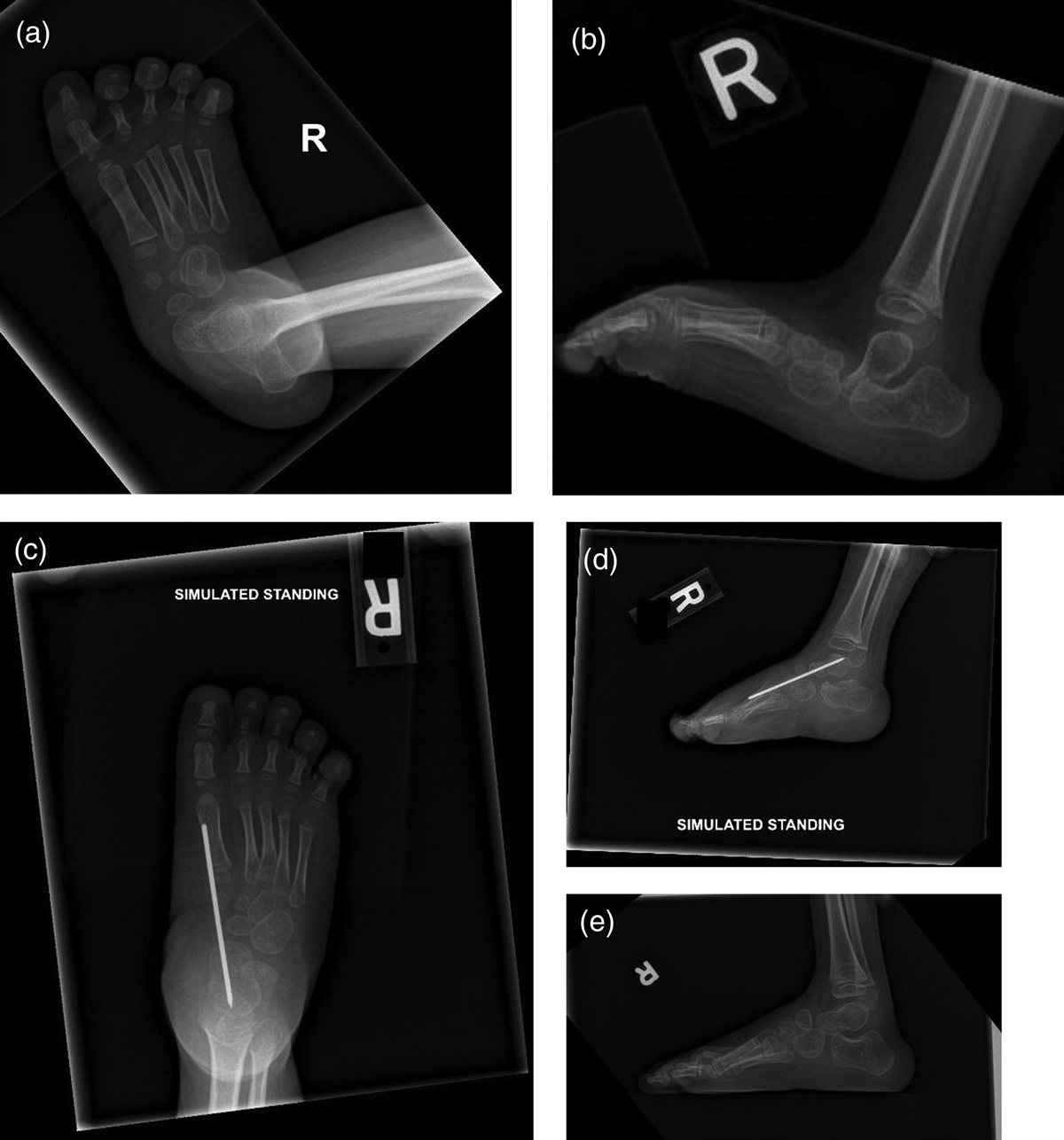 Untreated congenital vertical talus deformity in walking age: minimally invasive method works