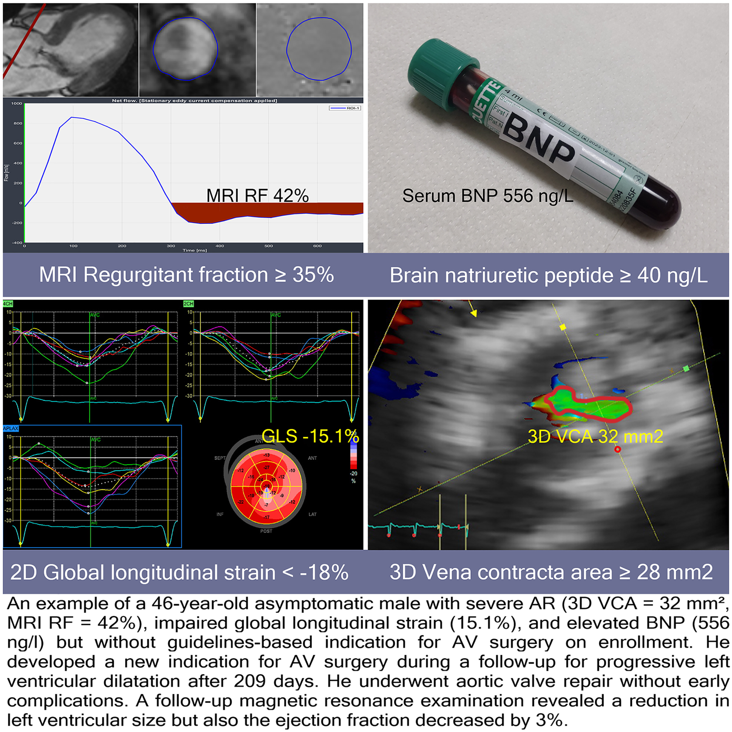 Multiparametric Strategy to Predict Early Disease Decompensation in Asymptomatic Severe Aortic Regurgitation