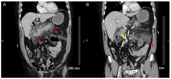 Tomography, Vol. 8, Pages 2946-2951: Intense FDG Uptake in the Common Bile Duct Post-ERCP Mimics Acute Infectious Cholangitis