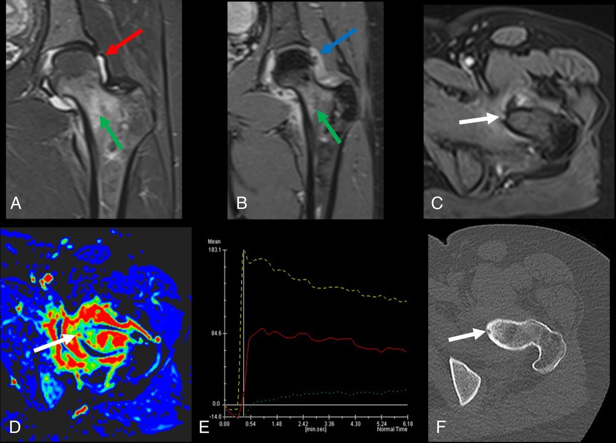Osteoid Osteoma Mimicking Arthritis