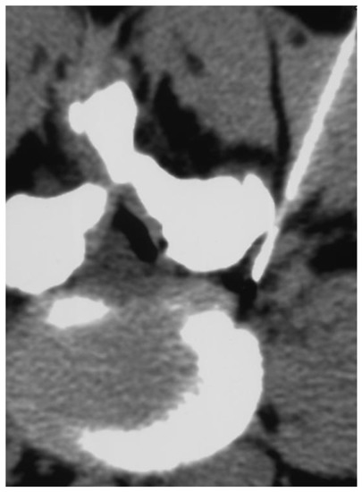 Biomedicines, Vol. 11, Pages 73: New Approach to Chronic Back Pain Treatment: A Case Control Study