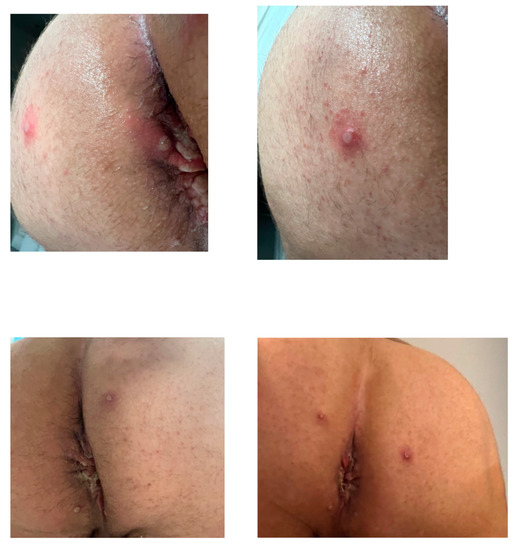 TropicalMed, Vol. 8, Pages 15: Mpox Infection in a Developed Country: A Case Report