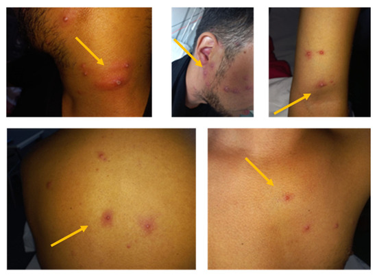 Vaccines, Vol. 11, Pages 63: First Case of Paraphimosis as a Severe Complication of Monkeypox
