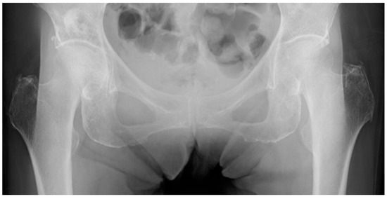 JPM, Vol. 13, Pages 53: Reliability of the Garden Alignment Index and Valgus Tilt Measurement for Nondisplaced Femoral Neck Fractures