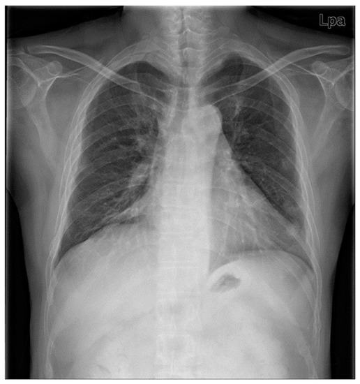 Medicina, Vol. 59, Pages 65: Respiratory Failure during BIS-Guided Sedation in a Patient with Relapsing Polychondritis: A Case Report