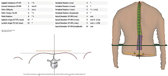 JCM, Vol. 12, Pages 218: An Investigation of the Association between 3D Spinal Alignment and Fibromyalgia