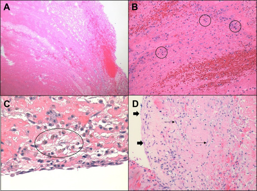 Microscopic Examination of Clots from Percutaneous Mechanical Embolectomies in Pulmonary Embolism