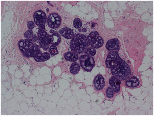 Pathology of Breast Cancer