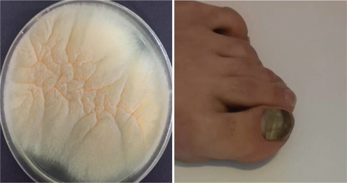 First report of onychomycosis caused by Phoma glomerata (Didymella glomerata): case report and literature review
