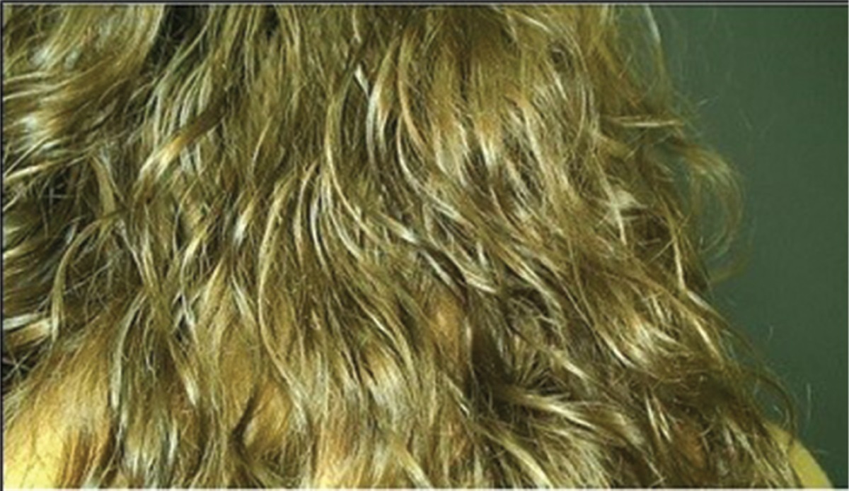 White piedra of the scalp caused by Trichosporon inkin: a case report with antifungal susceptibility testing and review of the literature