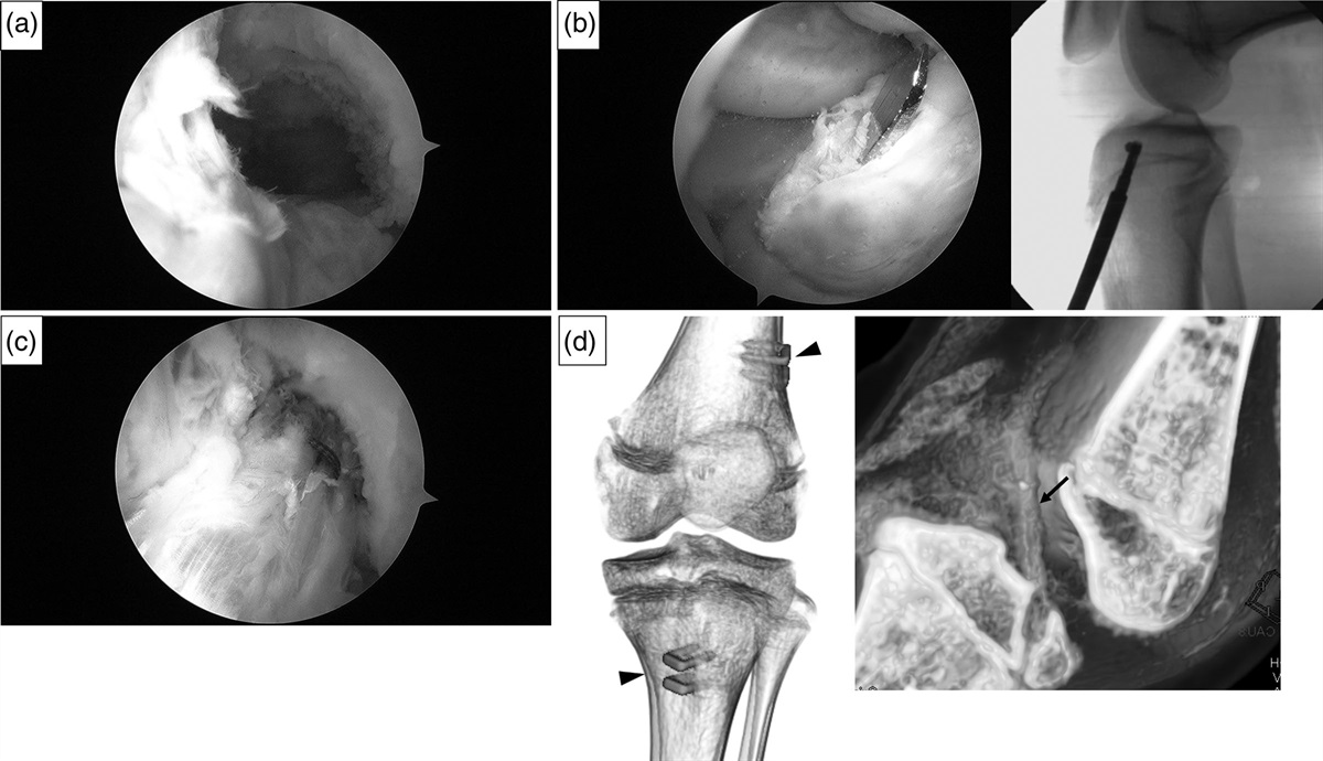 Comparison of clinical outcomes between anterior cruciate ligament reconstruction with over-the-top route procedure and anatomic single-bundle reconstruction in pediatric patients