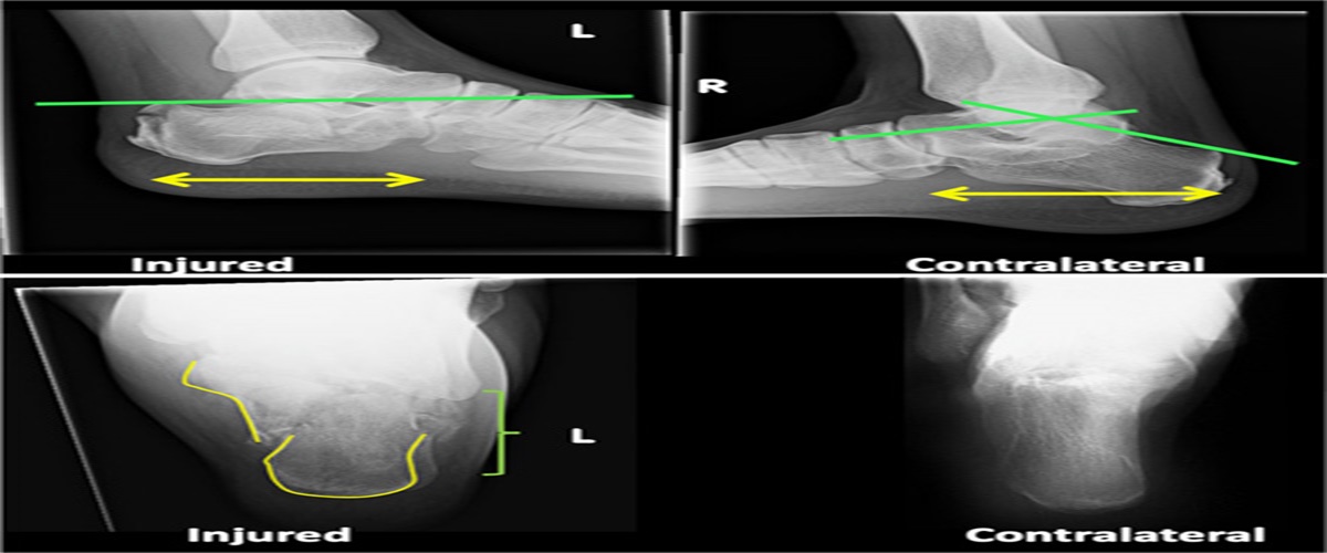 Provisional Reduction and External Fixation of Acute Displaced Intra-articular Calcaneus Fractures: Surgical Technique and Clinical Results
