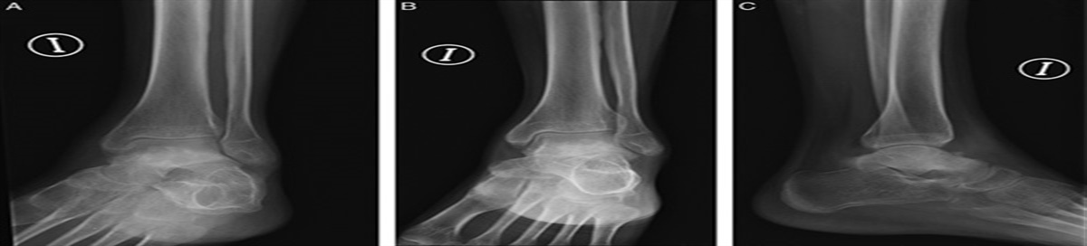 Patient-Specific Instruments for Resection and Reconstruction of Osteoblastoma in the Talus