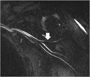 Peripheral Nerve Imaging