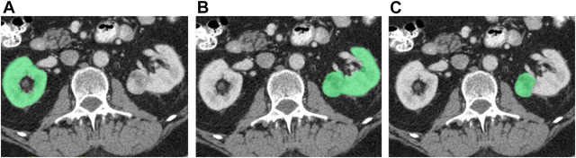 Long-Term Renal Function Following Renal Cancer Surgery