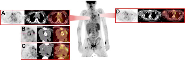 Radionuclide Imaging of Infective Endocarditis