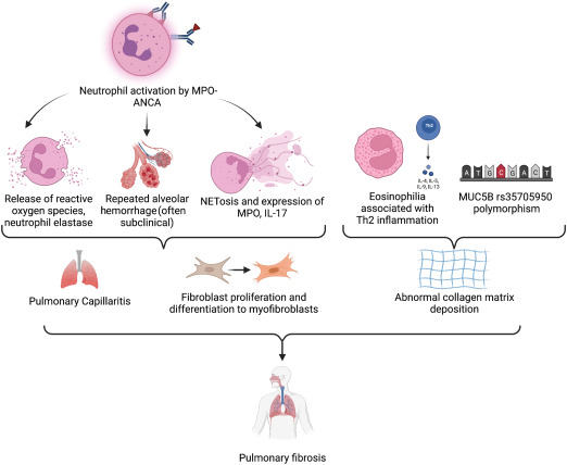 Interstitial Lung Disease and Anti-Neutrophil Cytoplasmic Antibody–Associated Vasculitis
